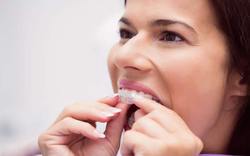 Invisalign Treatment - Oral Surgeon Beverly Hills, CA