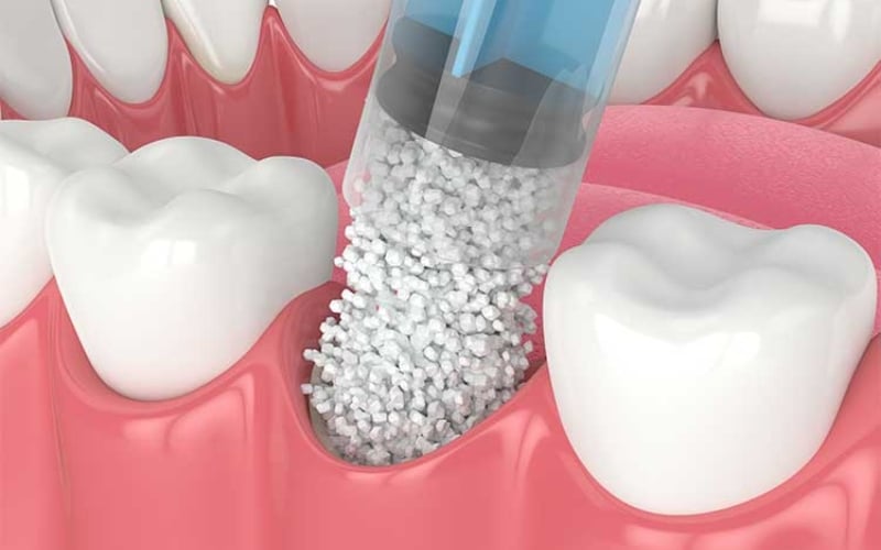 Bone Grafting For Implants - Beverly Hills Oral & Facial Surgeon, CA