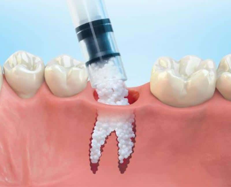Bone Grafting - Beverly Hills Oral & Facial Surgeon - Wisdom Teeth Removal & Dental Implants, CA