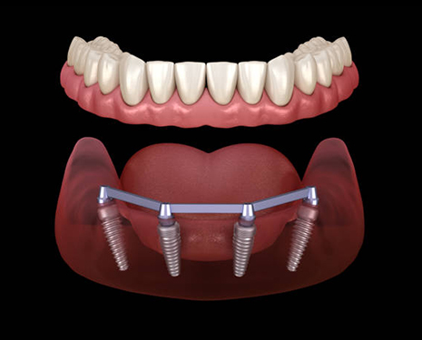 implant overdentures beverly hills