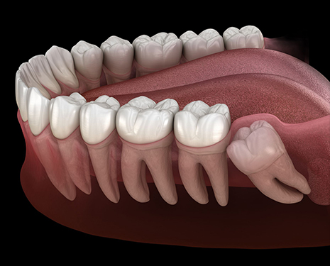 wisdom teeth extraction