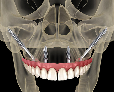 zygomatic implants beverly hills