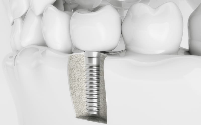 Signs of a Failed Dental Implant