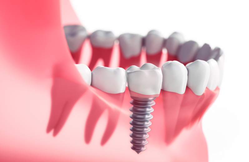 Top Five Advantages Of Same-Day Dental Implants: Insights From A Dentist