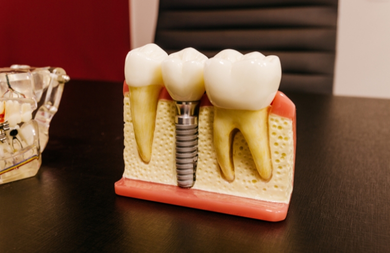 How Long Do Zirconia Implants Last?